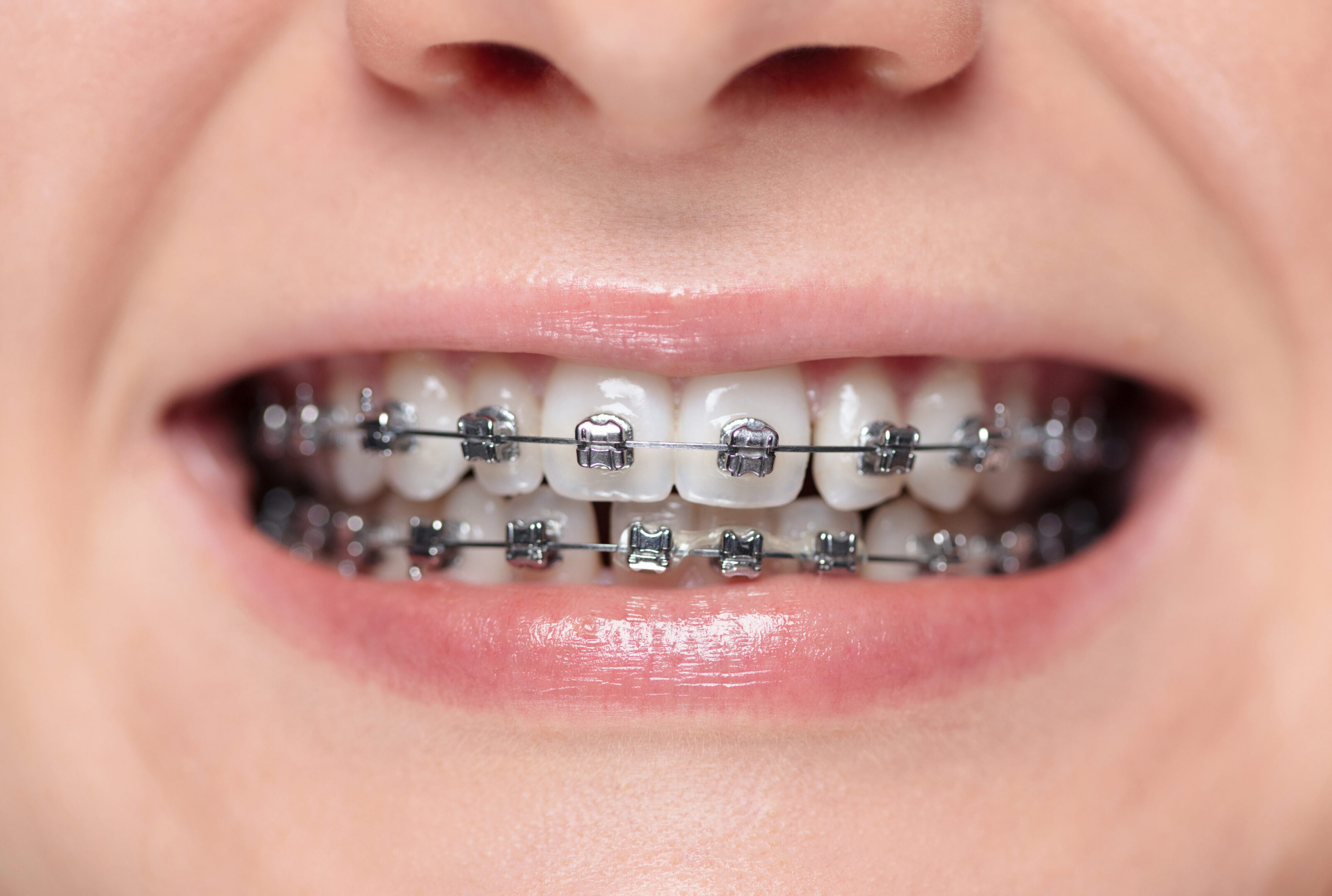 Close-up of smiling mouth with metal braces