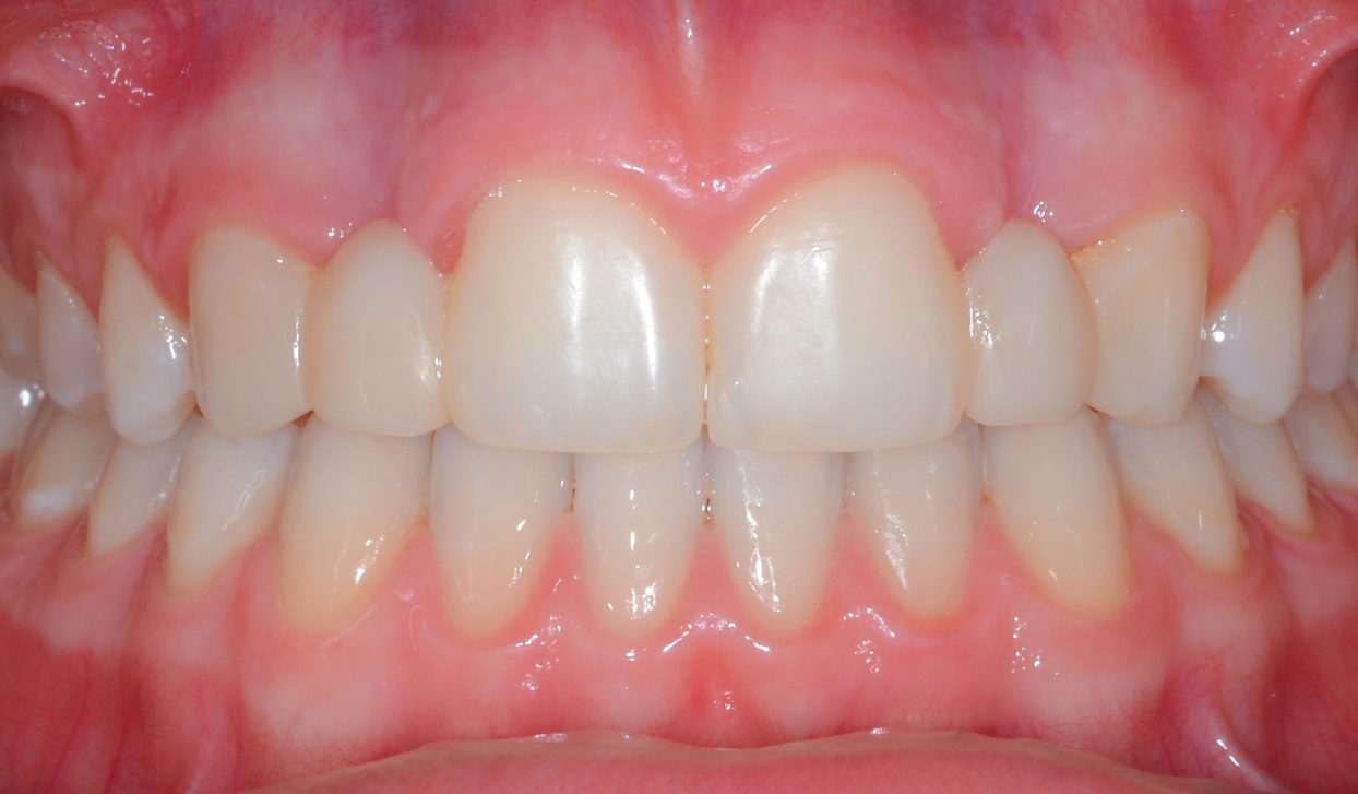 Close-up of straight white teeth and gums