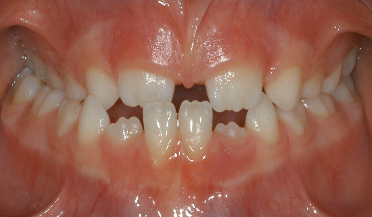 Close-up of teeth showing front spacing and crowding