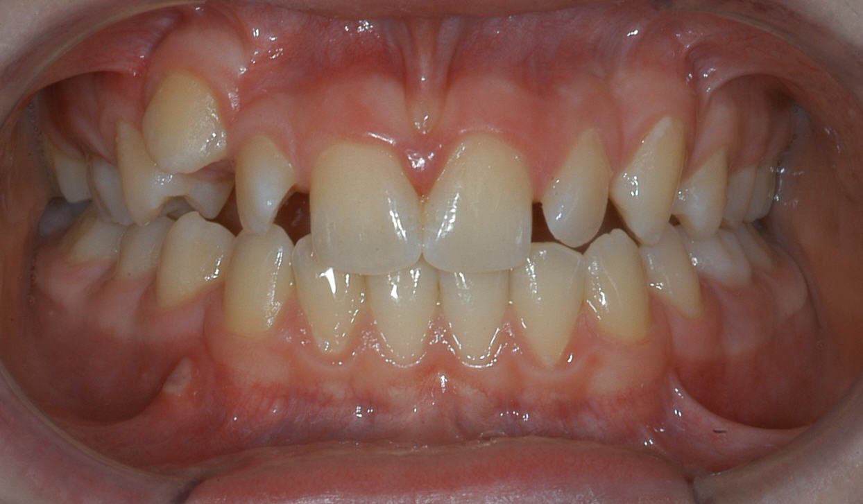Crowded teeth with dental malocclusion