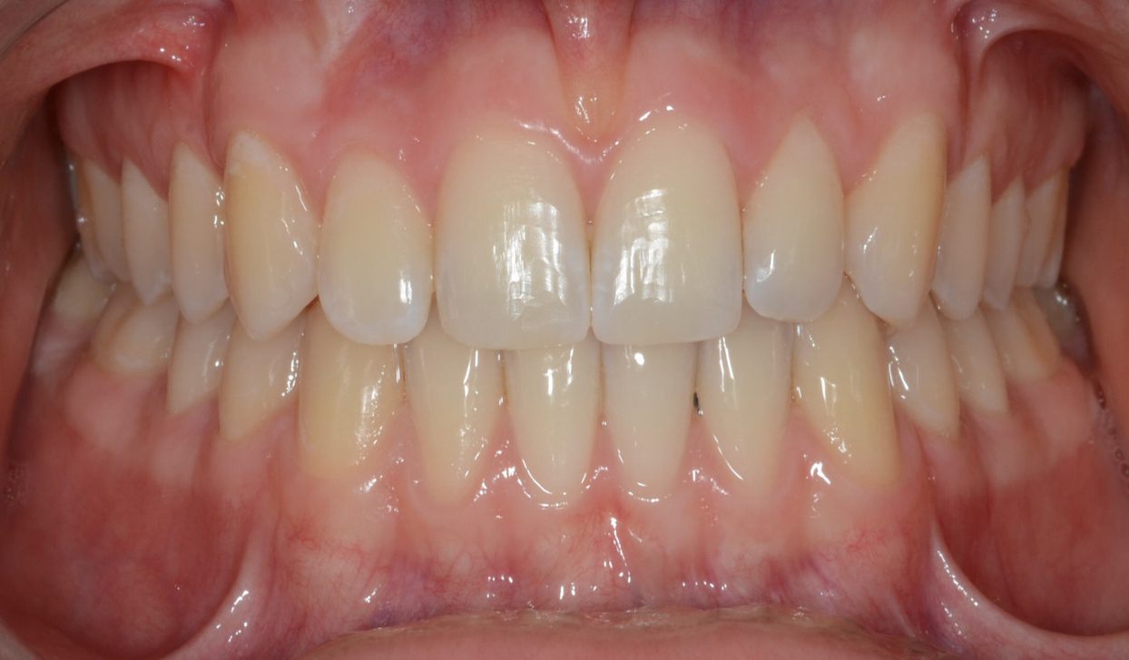 Frontal close-up of healthy aligned adult teeth