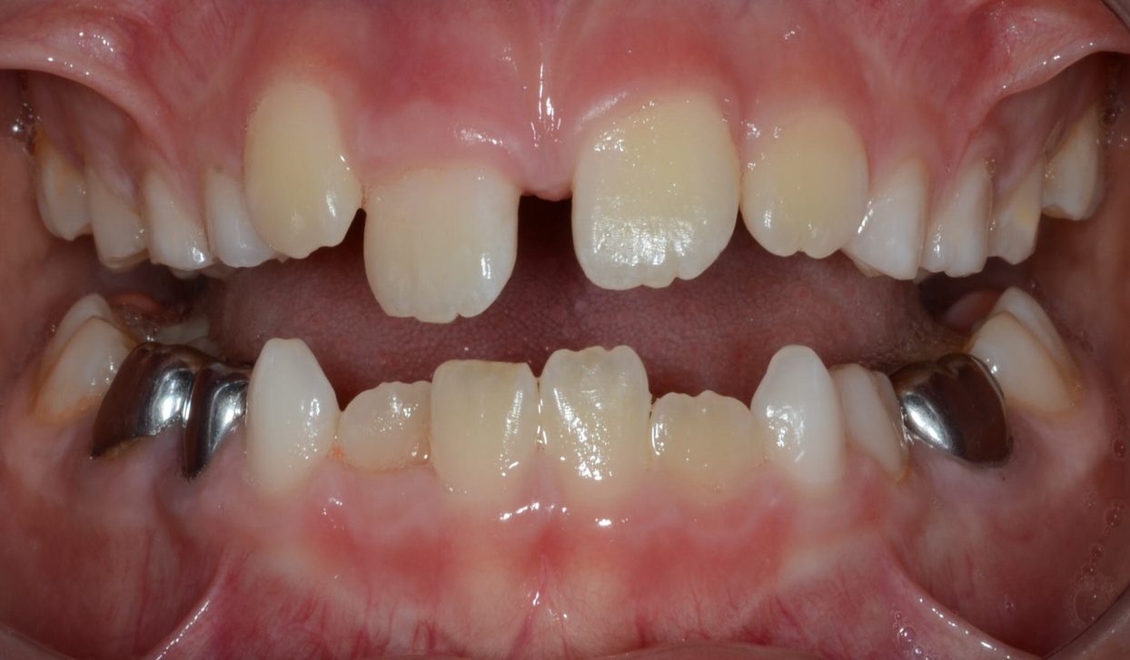 Close-up of teeth with gaps and metal crowns