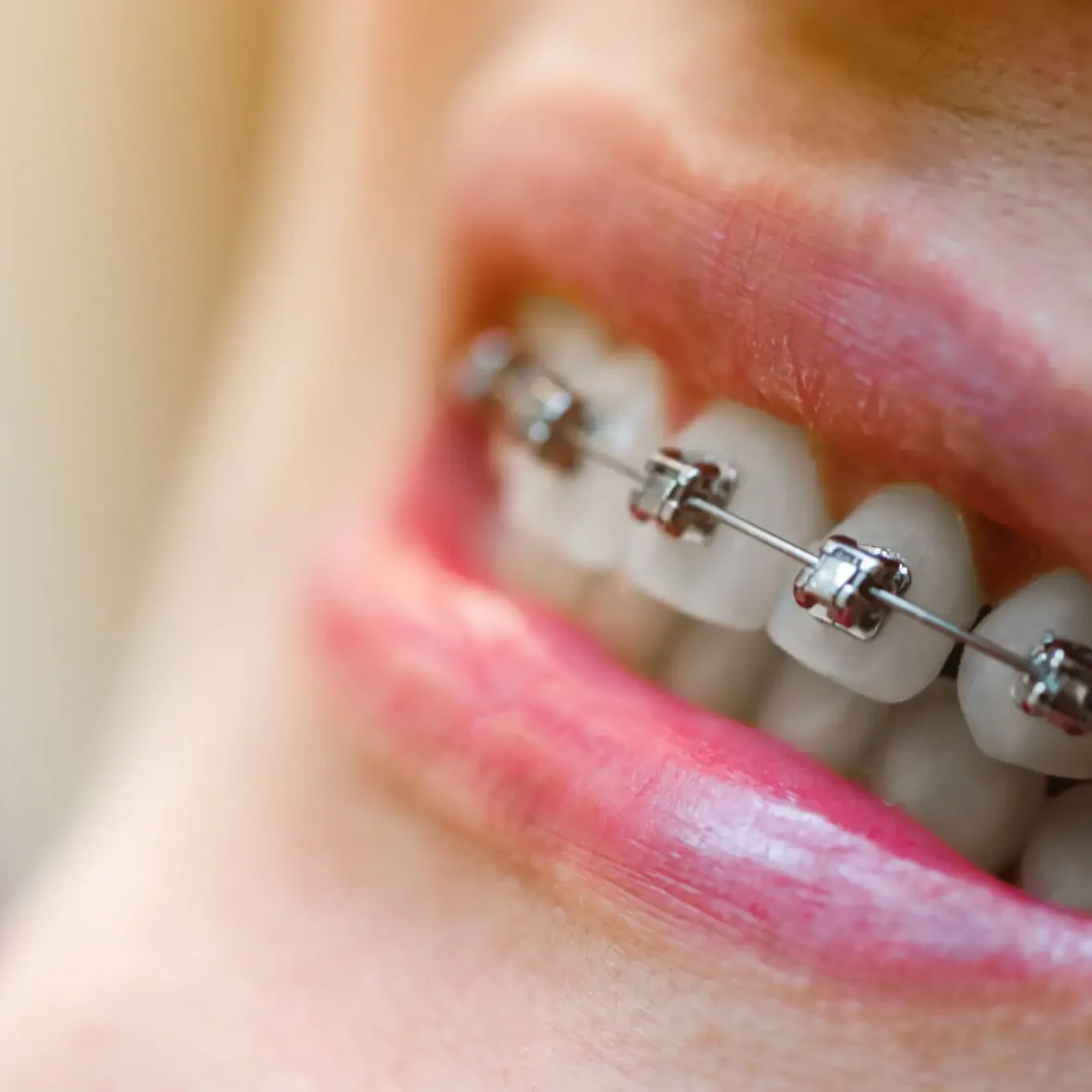 Close-up of teeth with metal braces